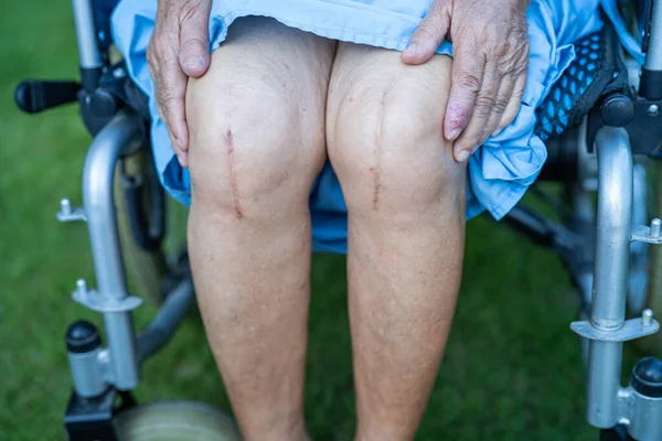 Asiática Senior Anciana Anciana Mujer Paciente Mostrar Sus Cicatrices Cirugía — Foto de Stock