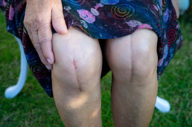 Asyalı yaşlı kadın hasta. Yaralarını gösteriyor. Diz eklemi ameliyatla değiştirilmiş..