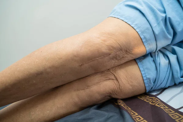 Aziatisch Senior Oudere Oude Dame Vrouw Patiënt Tonen Haar Littekens — Stockfoto