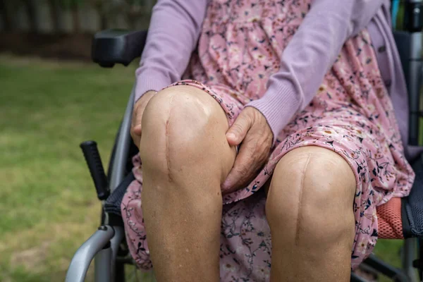 亚洲老年老年女性患者在护理病房的床上展示了她的疤痕手术全膝关节置换手术创伤性关节置换术 健康有力的医学理念 — 图库照片