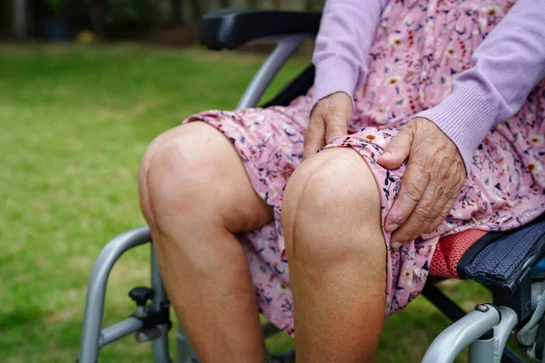 亚洲老年老年妇女患者在医院护理病房的床上展示了她的疤痕 外科全膝关节置换 缝合术 关节置换术 关节置换术 — 图库照片