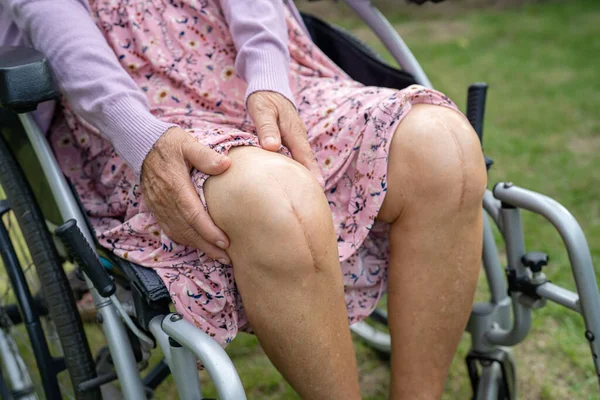 亚洲老年老年女性患者在护理病房的床上展示了她的疤痕手术全膝关节置换手术创伤性关节置换术 健康有力的医学理念 — 图库照片