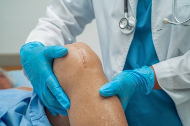 Asyalı yaşlı ya da yaşlı kadın hasta yaralarını gösteriyor. Diz eklemi ameliyatıyla değiştirilmiş. Hemşirelik hastanesi koğuşunda yatağında eklem iltihabı var..