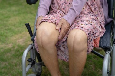 Asyalı yaşlı ya da yaşlı kadın hasta yaralarını gösteriyor. Diz eklemi ameliyatıyla değiştirilmiş. Hemşirelik hastanesi koğuşunda yatağında eklem iltihabı var..