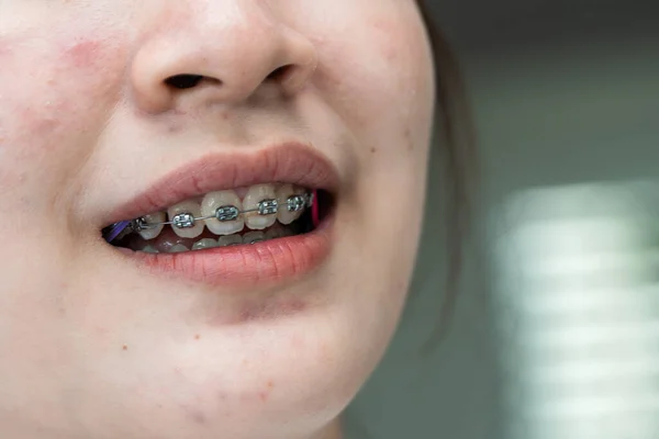 Braces Teenage Girl Mouth Treat Beauty Increase Confidence Good Personality — Stock Photo, Image