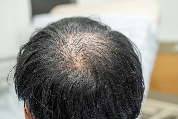 Лысый в средней голове и не начать потерю волос glabrous зрелого азиатского бизнеса умный активный офисный человек.