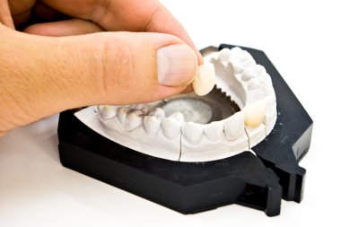 Plaster dental mold