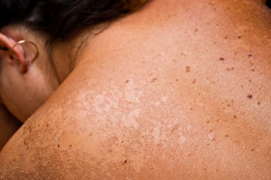 sunburned skin clipart