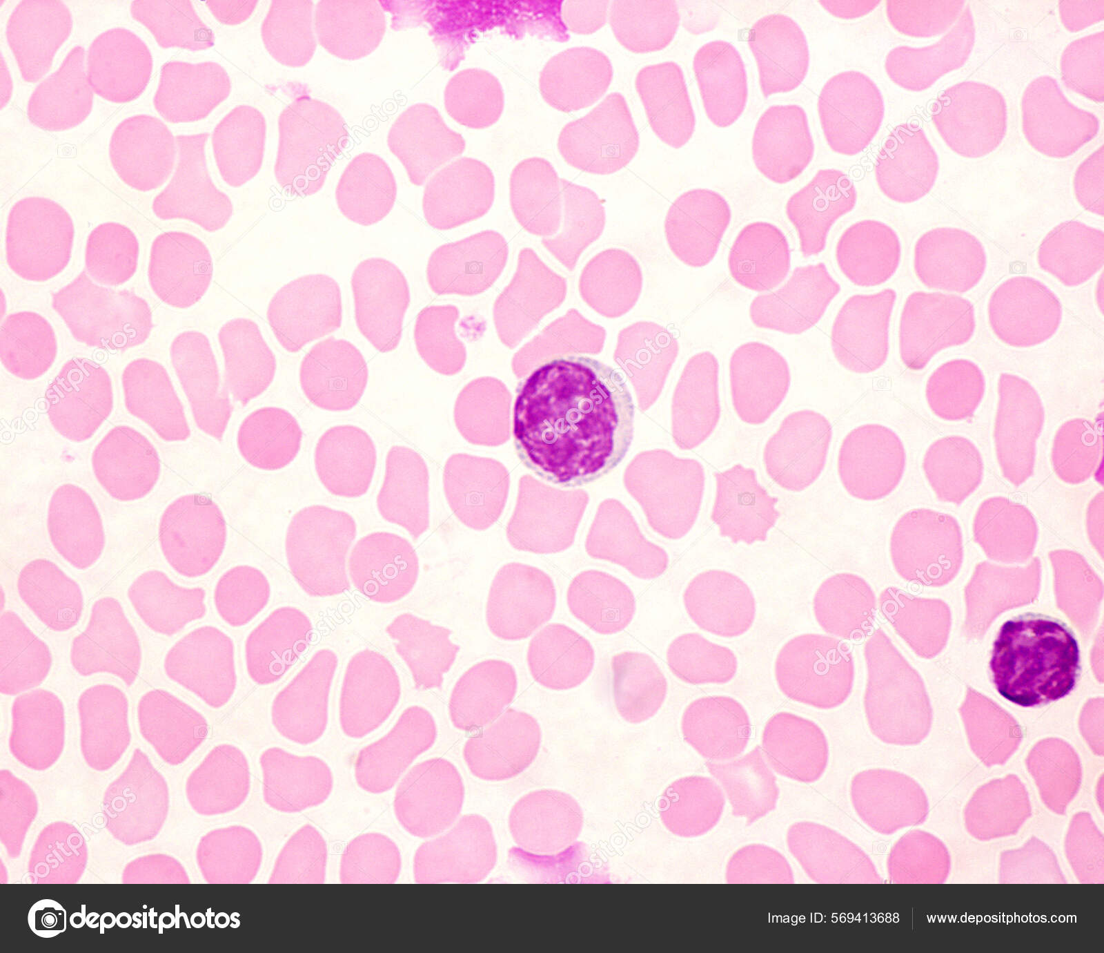 Human Blood Smear Showing Monocyte Center Right Small Bluish Stock Photo by ©jlcalvo@ucm.es 569413688