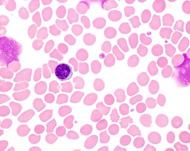 İnsan kanı lekesi lenfosit olduğunu gösteriyor. Kırmızı kan hücreleri arasındaki küçük mavimsi noktalar trombositlerdir..