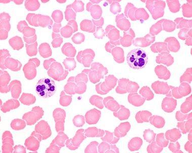 İnsan kanı lekesi. Akut enfeksiyonda lökositoz. Nükleer hipersegmentasyonlu nötrofil lökosit. Trombositler de kırmızı kan hücrelerinde görülür..