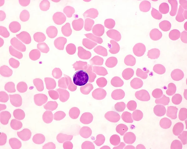 림프구를 적혈구 사이에 푸르스름 점들은 혈소판이다 — 스톡 사진