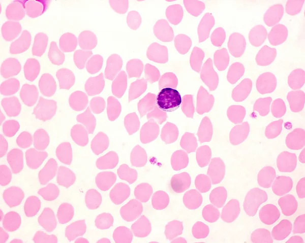 Esfregaço Sangue Humano Mostrando Linfócito Pequenos Pontos Azulados Entre Glóbulos — Fotografia de Stock