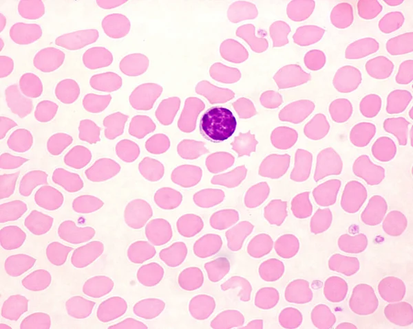 Human Blood Smear Showing Two Lymphocytes — Stock Photo, Image