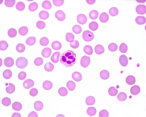 Esfregaço Sangue Humano Onde Observa Leucócito Neutrófilo Com Granulações Tóxicas — Fotografia de Stock