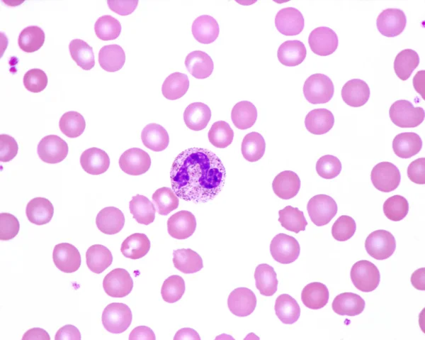 Rozmazání Lidské Krve Při Kterém Pozorován Nezralý Neutrofilní Leukocyt Pásková — Stock fotografie