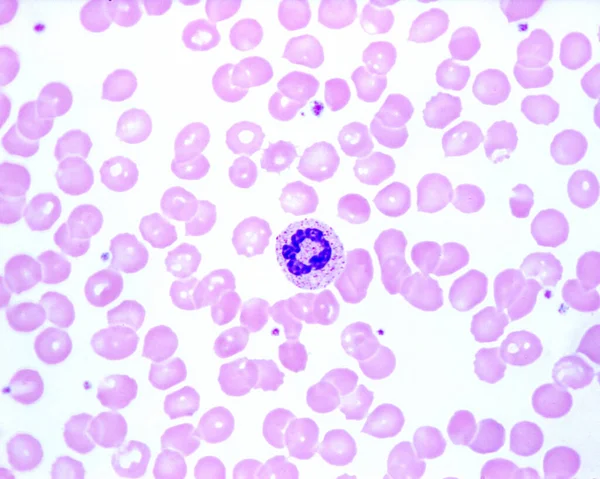 人类血液涂片显示一个中性粒细胞 其细胞质中有环状细胞核和有毒颗粒 红血球中的蓝色小点是血小板 — 图库照片