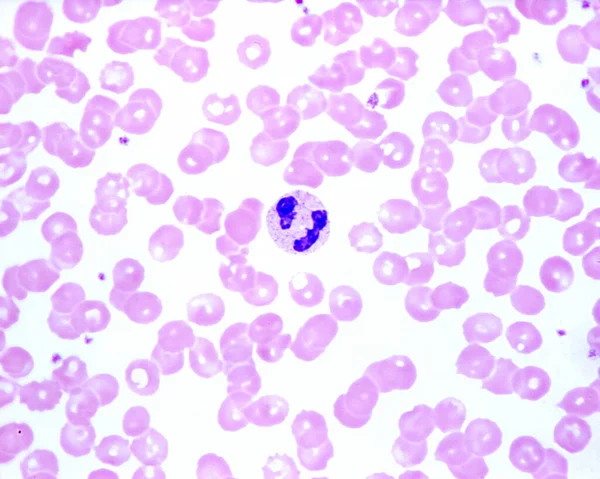 人的血液涂片显示中性粒细胞白血病细胞具有多瓣带细胞核 和多瓣带细胞核 红血球中的蓝色小点是血小板 — 图库照片