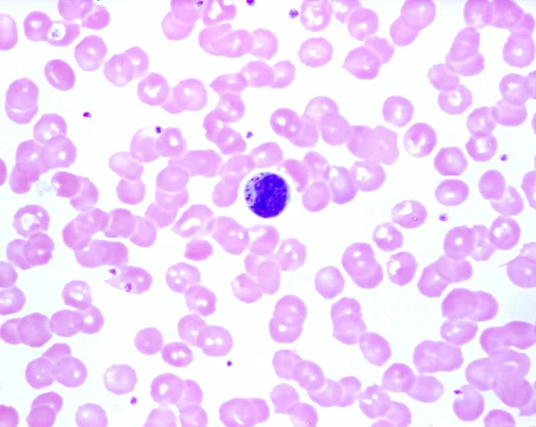 Rozmaz Ludzkiej Krwi Wykazujący Reaktywną Limfocyt Granulkami Cytoplazmie Mononukleozie Zakaźnej — Zdjęcie stockowe