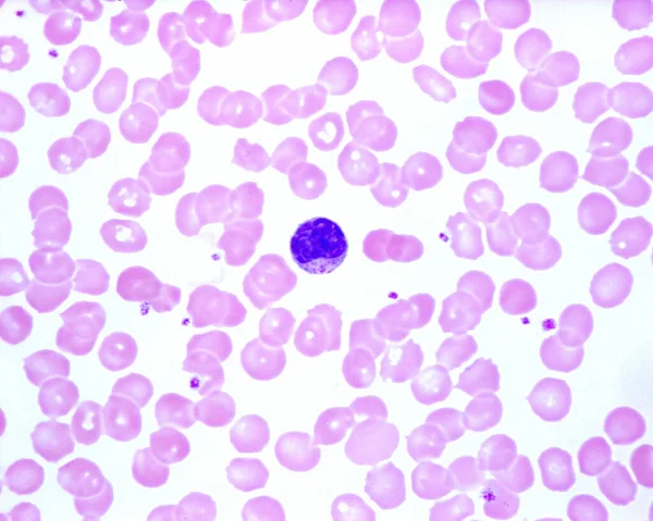 ヒトの血液は単球を示す 赤血球の中の小さな青い点は血小板です — ストック写真