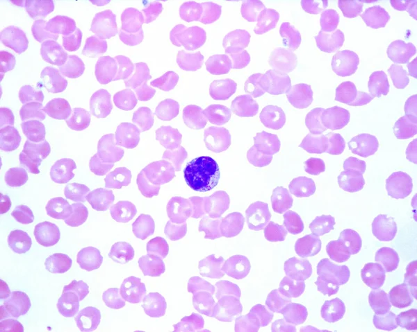 人类血液涂片显示 在传染性单核细胞病中 淋巴细胞的细胞质中有颗粒 红血球中的蓝色小点是血小板 — 图库照片