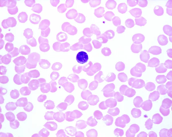 リンパ球を示すヒトの血液スミア 赤血球の中の小さな青い点は血小板です — ストック写真