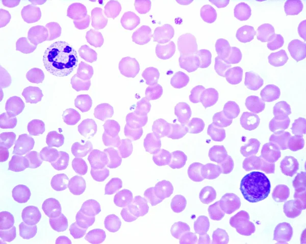 人血涂片显示中性粒细胞白血病 和淋巴细胞 红血球中的蓝色小点是血小板 — 图库照片