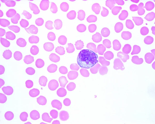 人血涂片显示单核细胞白血病细胞 有一个裂片状的细胞核 它是最大的白细胞 与红细胞的大小相比 — 图库照片