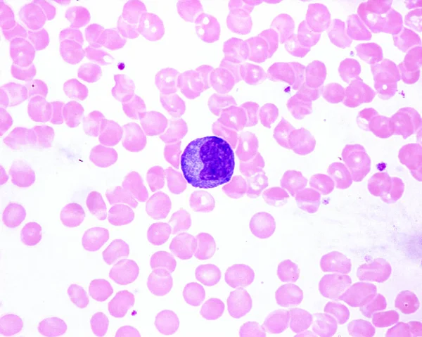 의피에는 전염성 단핵증에 세포가 세포가 백혈구 크기와 비교해 백혈구이다 — 스톡 사진