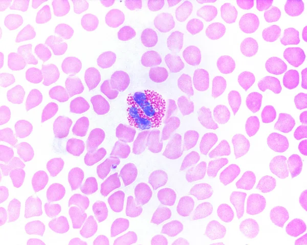 人血涂片表现为嗜酸性粒细胞白细胞 有丰富的红色颗粒和一个有特征的双核 — 图库照片