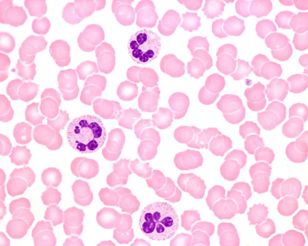 Ανθρώπινη Κηλίδα Αίματος Λευκοκυττάρωση Οξεία Λοίμωξη Λευκοκύτταρα Ουδετερόφιλων Πυρηνική Υπερκατάτμηση — Φωτογραφία Αρχείου