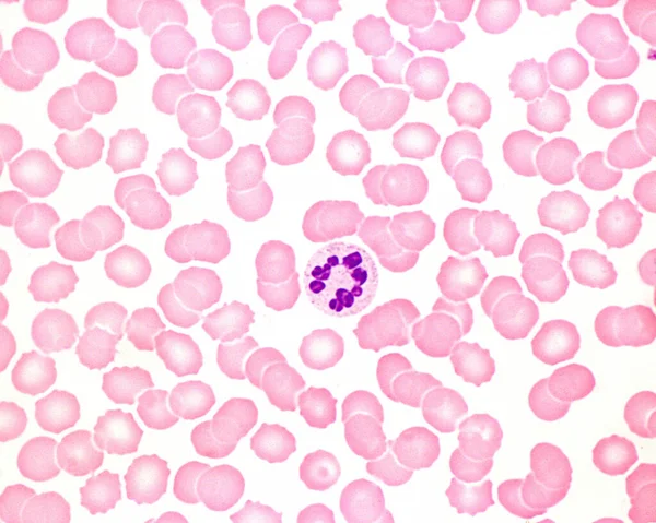 人类的血被抹黑了急性感染中的白血病细胞病 中性粒细胞白血病细胞核超分割 — 图库照片