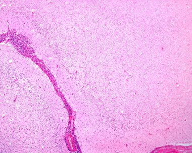 Ensefalopati (IAE) ile ilişkili bir gribin mikroskop mikroskobu. Menenjit ve sinirsel parenksima şiddetli iltihaplanma olduğunu gösteriyor..