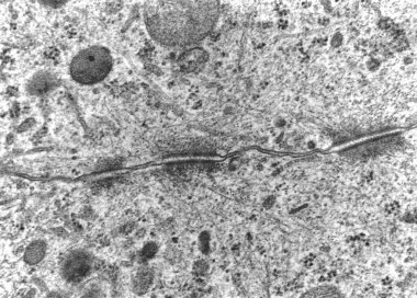 Transmission electron micrograph (TEM) showing a desmosome (macula adherens) with prominent dense plaques where keratin intermediate filaments were attached.  clipart