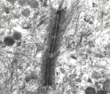 Transmission electron micrograph (TEM) showing two desmosomes (maculae adherentes) with prominent dense plaques where keratin intermediate filaments were attached. clipart
