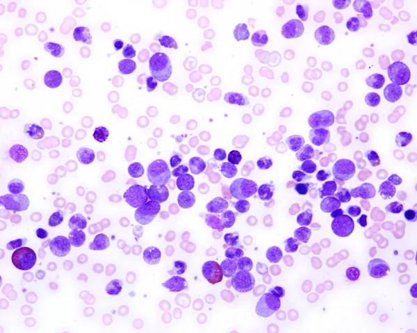 Leucemia Mielóide Crónica Micrografia Luz Esfregaço Sangue Paciente Com Leucemia — Fotografia de Stock