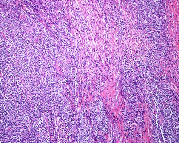 Low magnification micrograph showing a reticulosarcoma, a malignant lymphoma, infiltrating the muscular layer of the stomach.