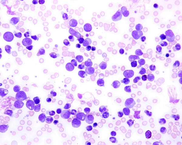 慢性粒细胞白血病 慢性髓细胞性白血病或粒细胞性白血病患者血液涂片的光镜 这是一种骨髓癌 在这种癌症中 粒细胞前体或成骨细胞充满了骨髓细胞 — 图库照片