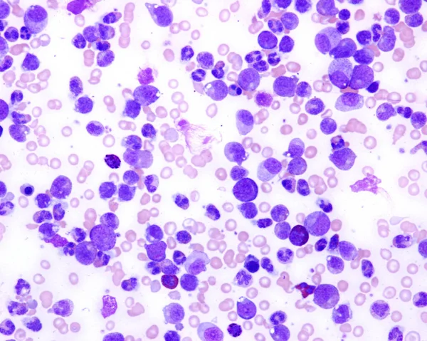 Chronická Myeloidní Leukémie Světelný Mikrograf Nátěru Krve Pacienta Chronickou Myeloidní — Stock fotografie