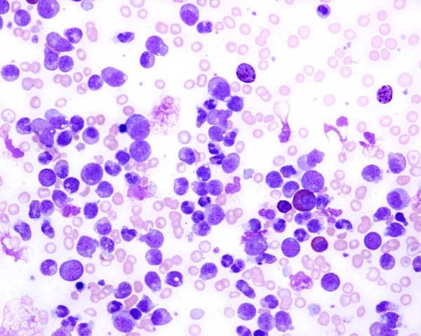 Chronic Myeloid Leukaemia Light Micrograph Blood Smear Patient Chronic Myeloid — Foto de Stock