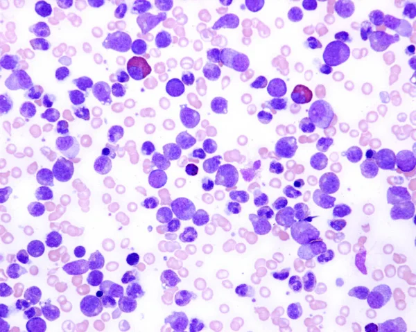 Leucemia Mielóide Crónica Micrografia Luz Esfregaço Sangue Paciente Com Leucemia — Fotografia de Stock