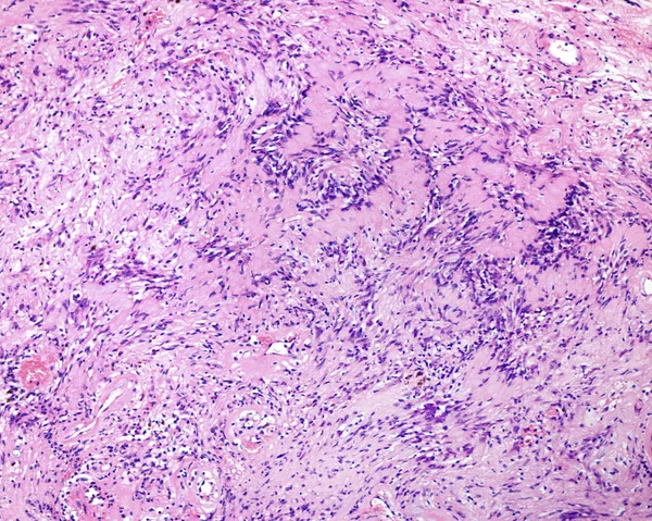 Nörilemmoma Schwannoma Çevresel Sinir Kılıfından Türetilen Perinöral Schwann Hücrelerinden Oluşan — Stok fotoğraf