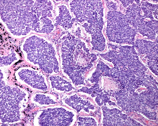 Human lung. Small cell carcinoma. Clusters and sheets of small cells, round to oval to spindle-shaped, finely granular chromatin, and very scant cytoplasm, numerous mitotic figures, and central areas of necrosis.