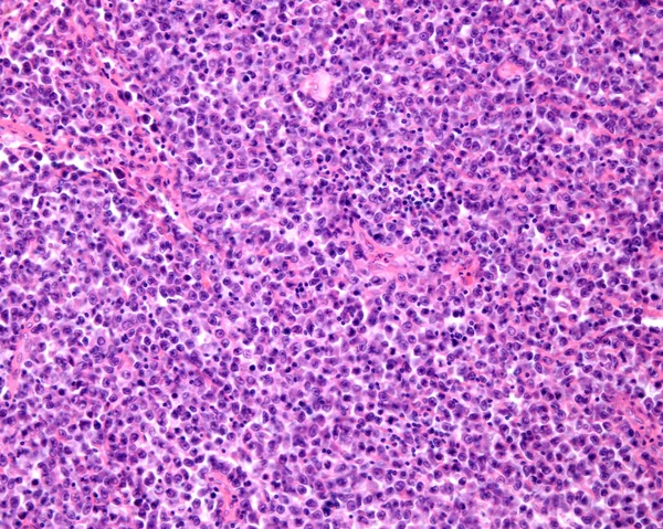 网状肉瘤网状肉瘤是一种恶性淋巴瘤 其淋巴结的光镜检查 淋巴结的正常结构完全被肉瘤癌细胞占据 — 图库照片