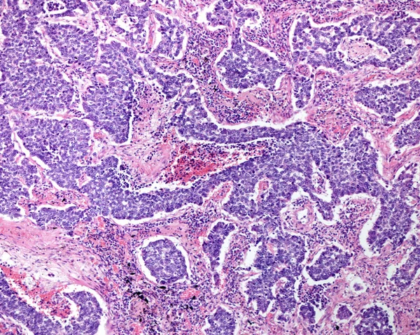 Human lung. Small cell carcinoma. Clusters and sheets of small cells, round to oval to spindle-shaped, finely granular chromatin, and very scant cytoplasm, numerous mitotic figures, and central areas of necrosis.