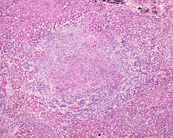 Human liver. Cholangiocarcinoma. Nodule of tumour cells showing central necrosis and inflammatory infiltrates, surrounded by normal hepatocytes.