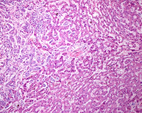 Colangiocarcinoma Intrahepático Tipo Ductal Estructuras Ductales Malignas Formadas Por Glándulas — Foto de Stock