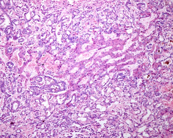 肝内胆管癌 导管型 由不正常和复杂的腺体和管状物与淋巴浆液混合形成的恶性导管结构 — 图库照片