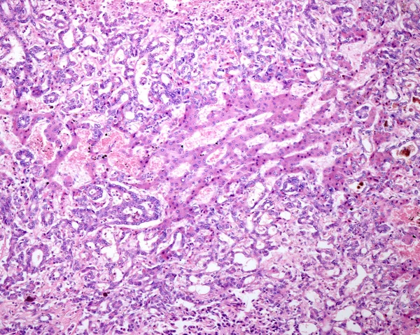 Cololangiocarcinoma Intraepatico Tipo Duttale Strutture Duttulari Maligne Formate Ghiandole Tubuli — Foto Stock