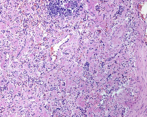 Human spleen amyloidosis. Amyloidosis is caused by abnormal folding of normal soluble proteins leading to fibril formation. These clumps of protein are called amyloid deposits. The spleen is involved in most cases of systemic amyloidosis. The microgr